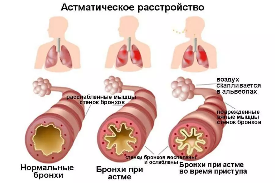 Аллергия на кальян